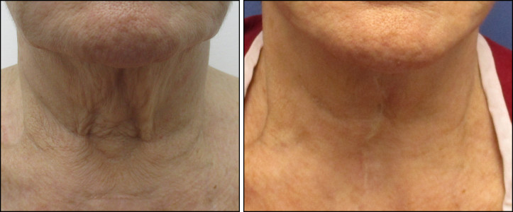 facelift